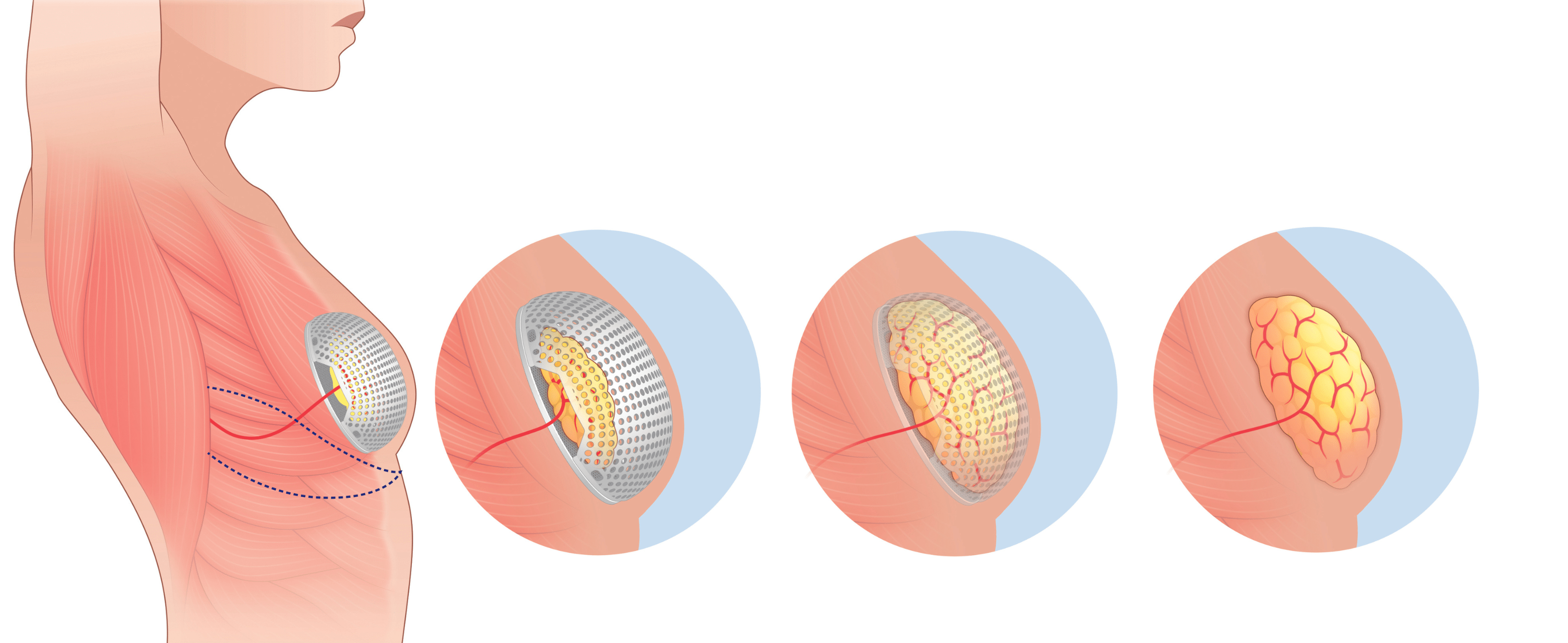 Implant Mattisse